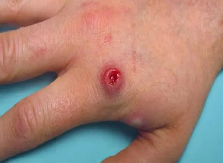 Понимание MonkeyPox и как это предотвратить？