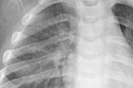 Быстрое обнаружение хламидий Pneumoniae: надежное и эффективное